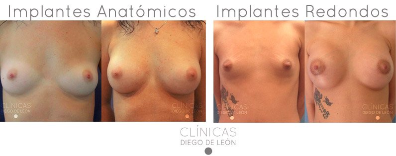 Tipos de prótesis aumento de senos