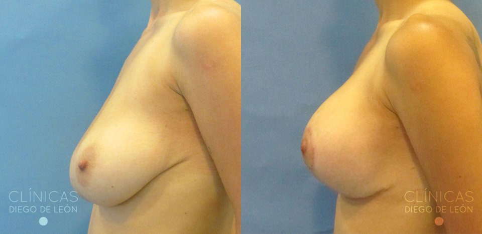 antes y despues mastopexia con implantes