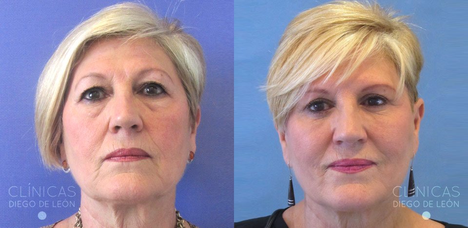Hilos tensores y blefaroplastia