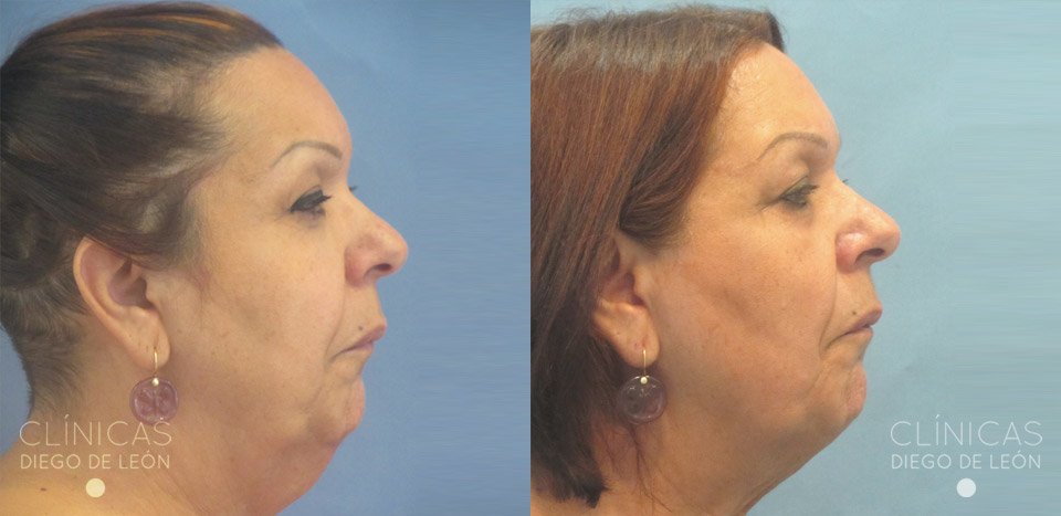 Experiencia Liposucción Papada