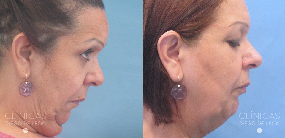Testimonio Liposucción Papada