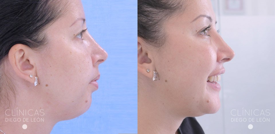 Fotos de pacientes de Mentoplastia