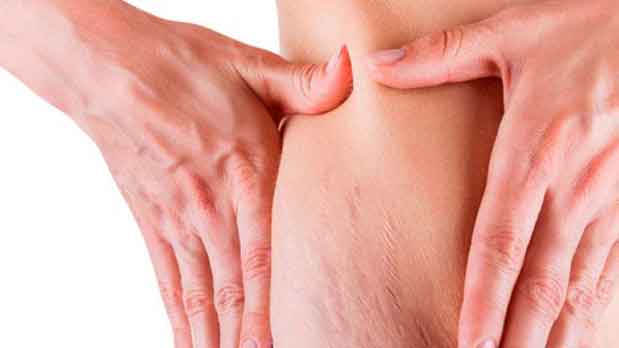 Estrías tras el embarazo