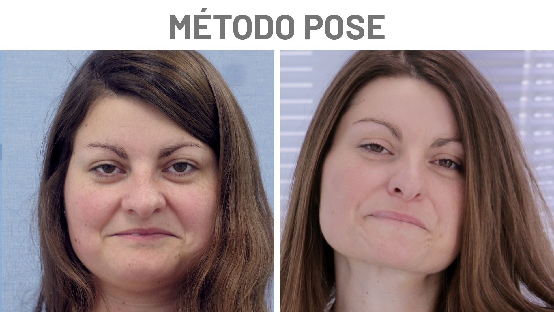 Reducción de estómago con método POSE: testimonio antes y después