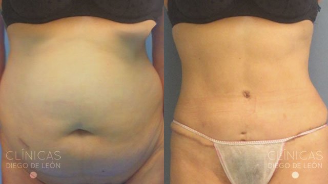 abdominoplastia antes y despues