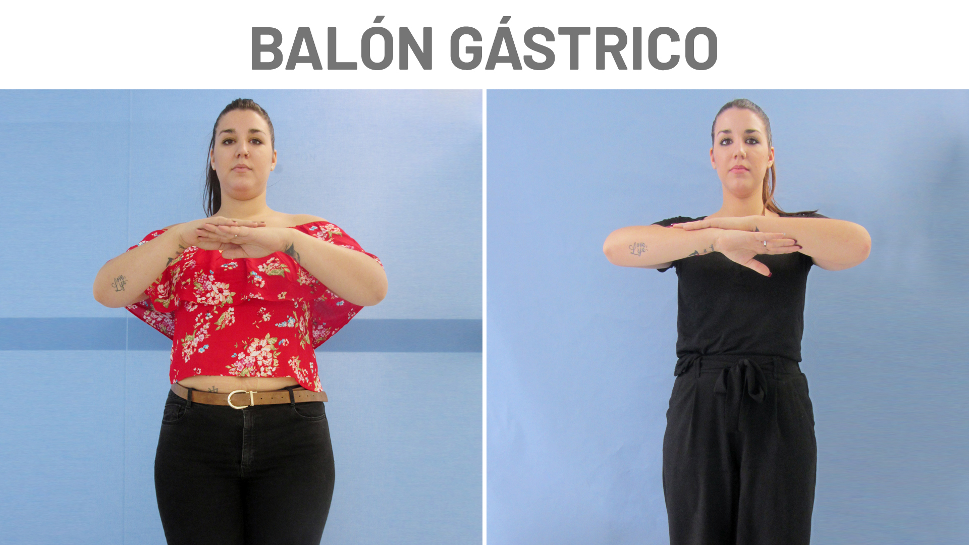 Balón intragástrico: testimonio