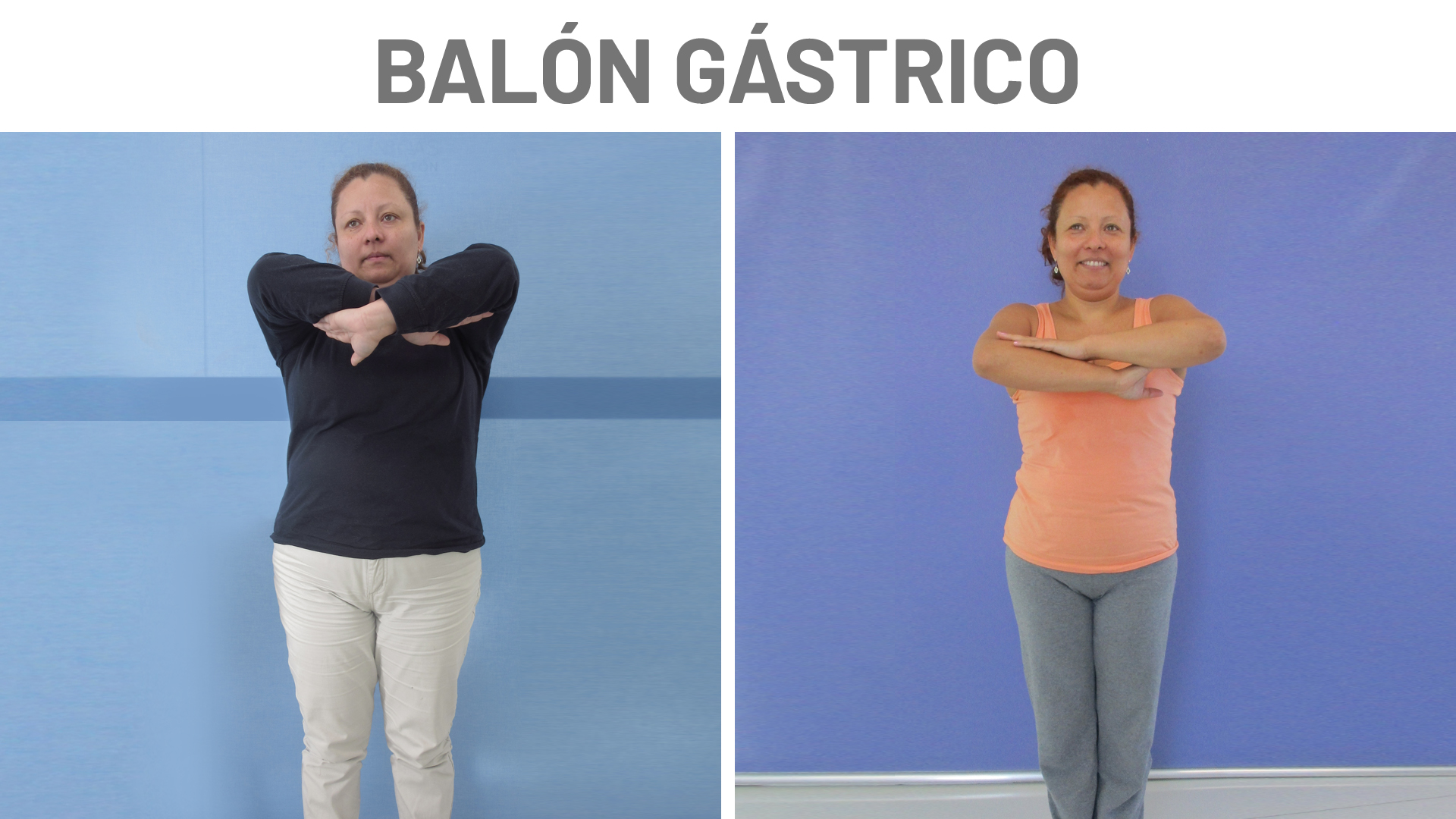 Balón gástrico: testimonio Kery