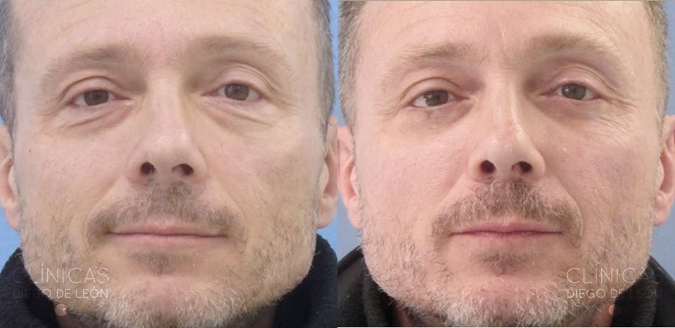 Blefaroplastia inferior hombres | Clínicas Diego de León