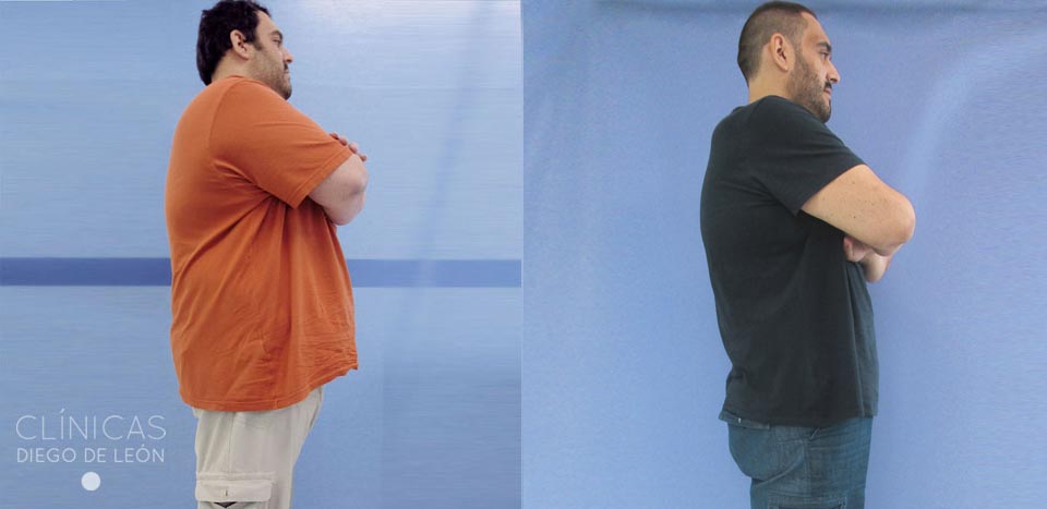 Antes y después Bypass gástrico | Clínicas Diego de León Antes y después Bypass gástrico | Clínicas Diego de León