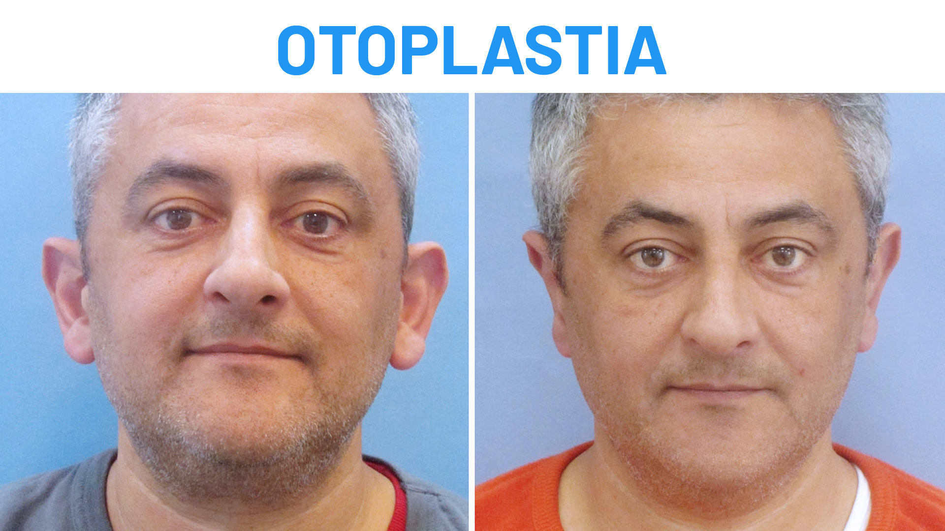 Otoplastia antes y después