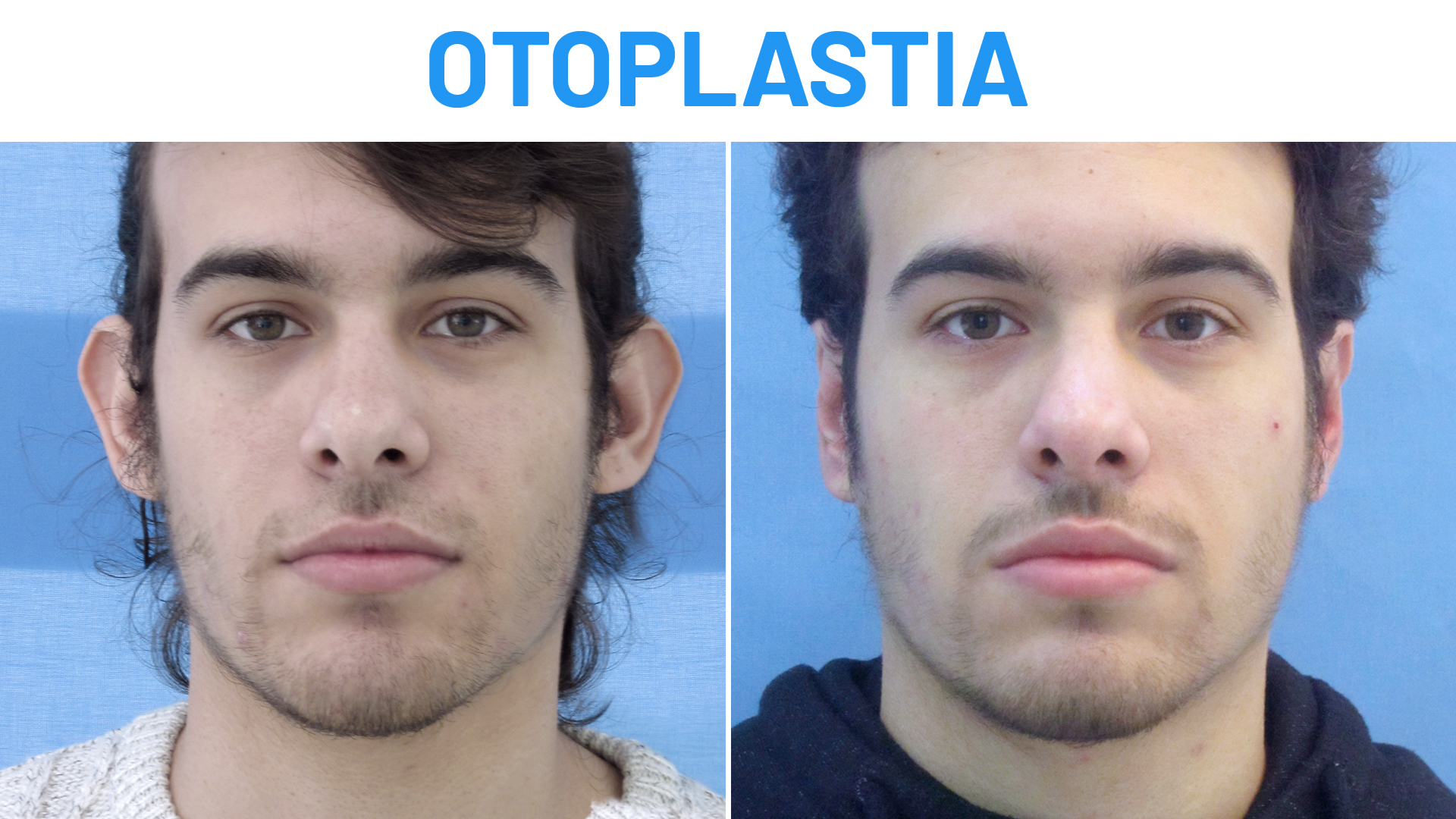 Otoplastia: testimonio antes y después