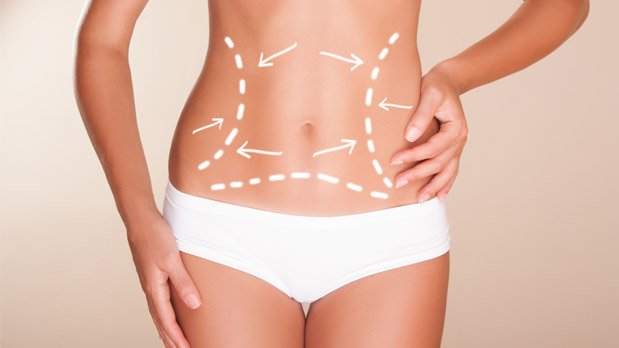 zonas liposuccion abdominal