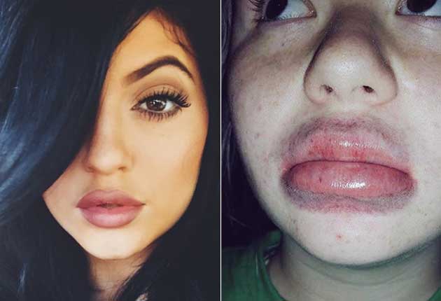 Tratamientos no recomendados de aumento de labios