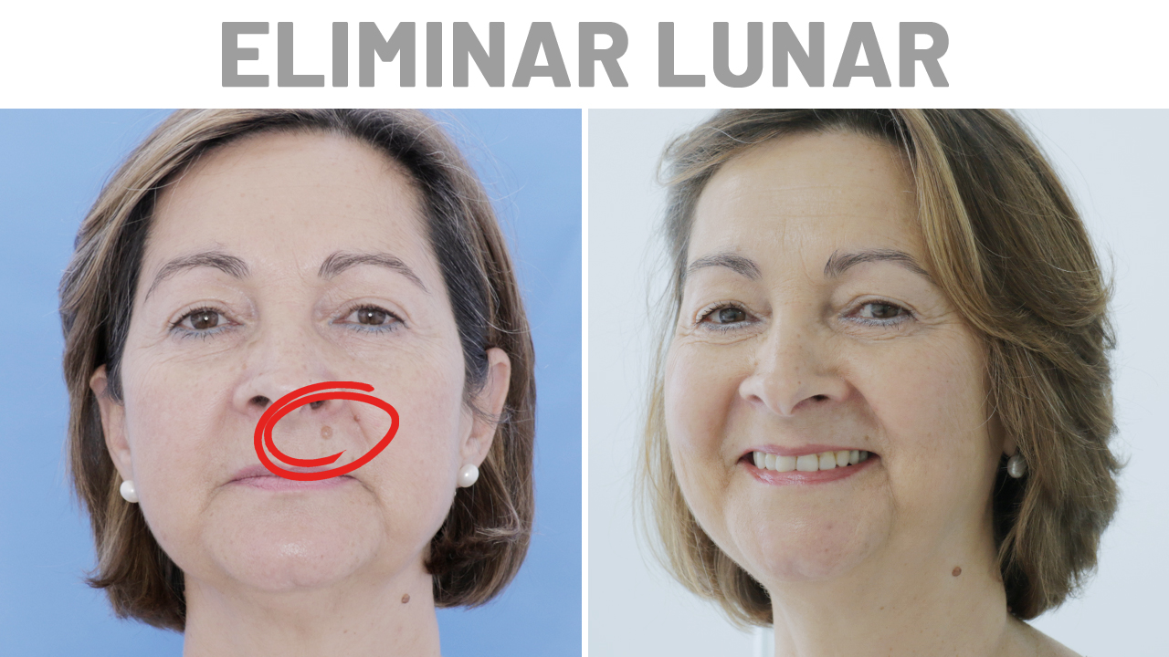 Eliminación de lunares con láser antes y después