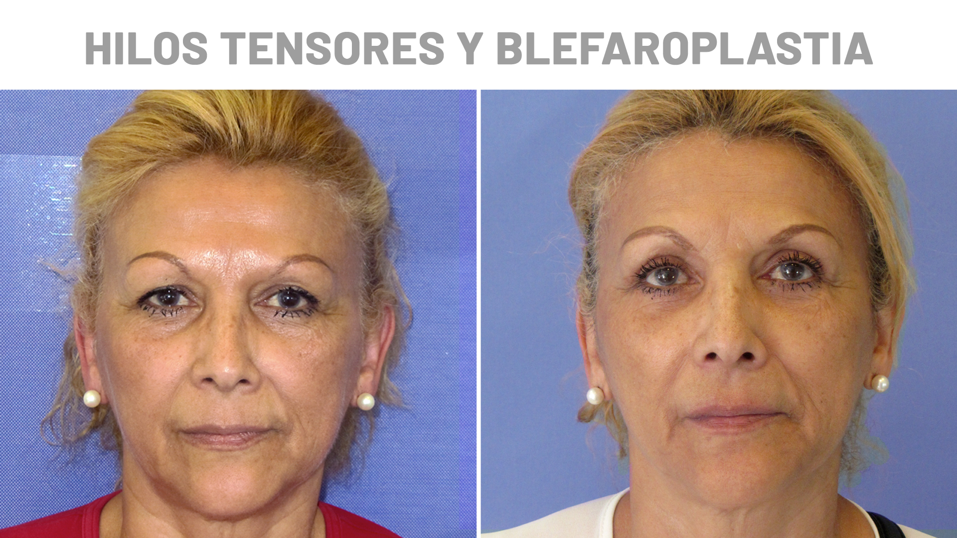 Blefaroplastia e hilos tensores antes y después