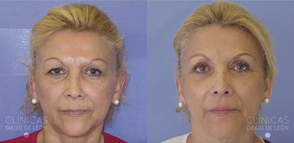 Blefaroplastia hilostensores | Clínicas Diego de León