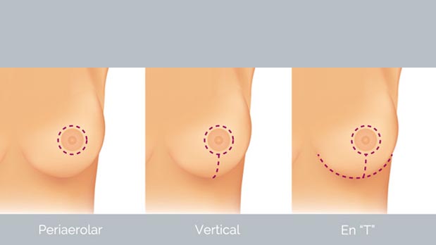 Tipos de incisión que se pueden practicar en una mastopexia.