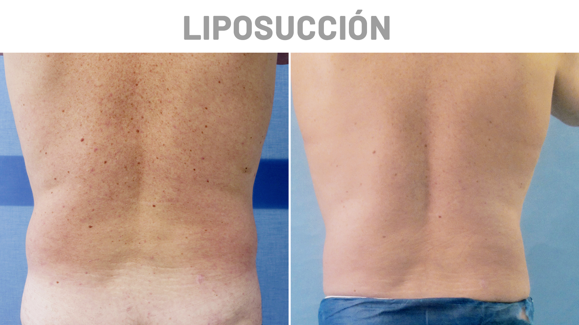Liposucción masculina antes y después