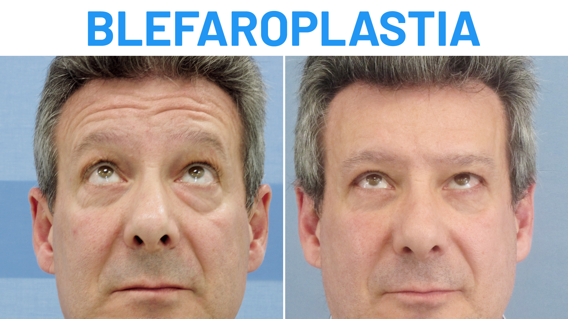 Blefaroplastia antes y después