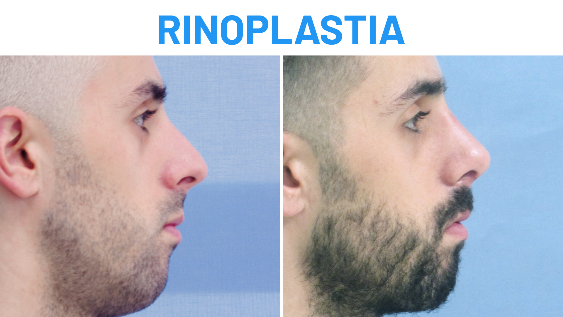 Rinoplastia antes y después