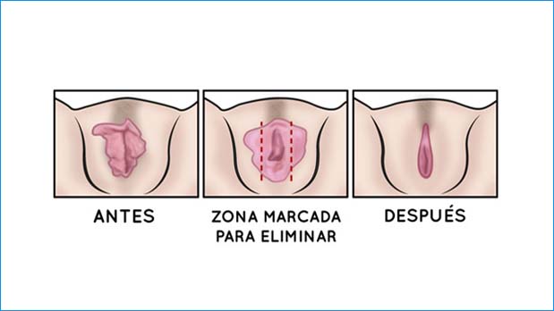 cirugia labios genitales