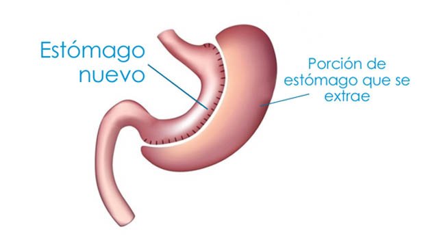 reduccion de estomago manga gastrica