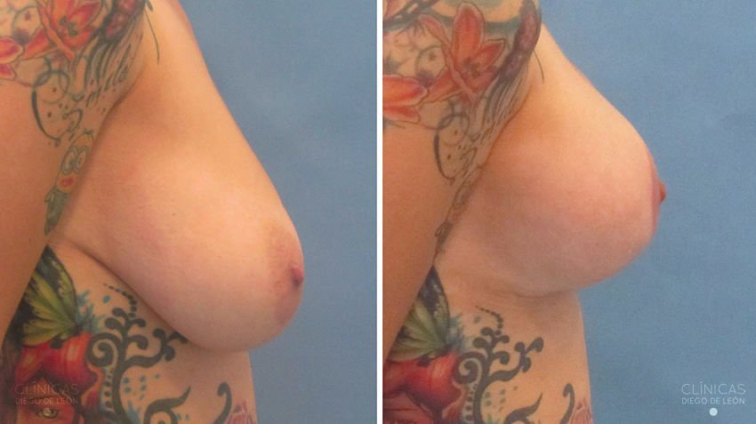 mastopexia con implantes resultados
