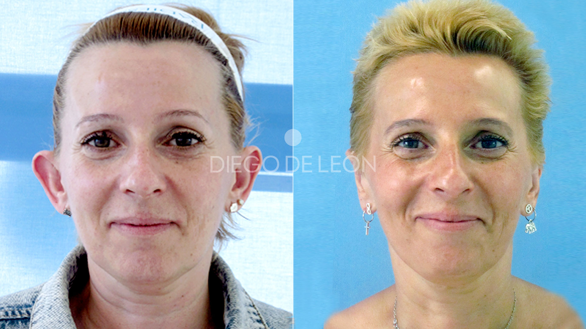 Otoplastia testimonio y antes y después