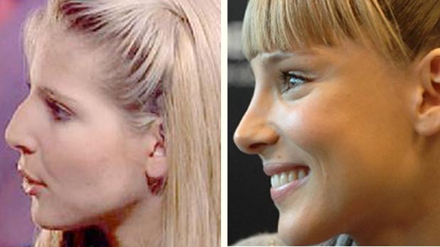 elsapataky-rinoplastia