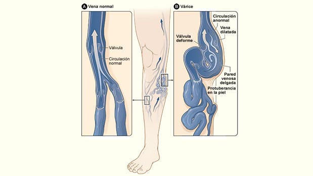Las varices son venas inflamadas por la imposibilidad del paso de sangre a través de ellas.