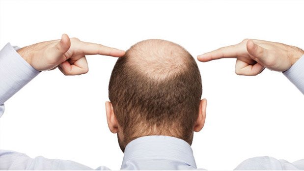 alopecia-hombres