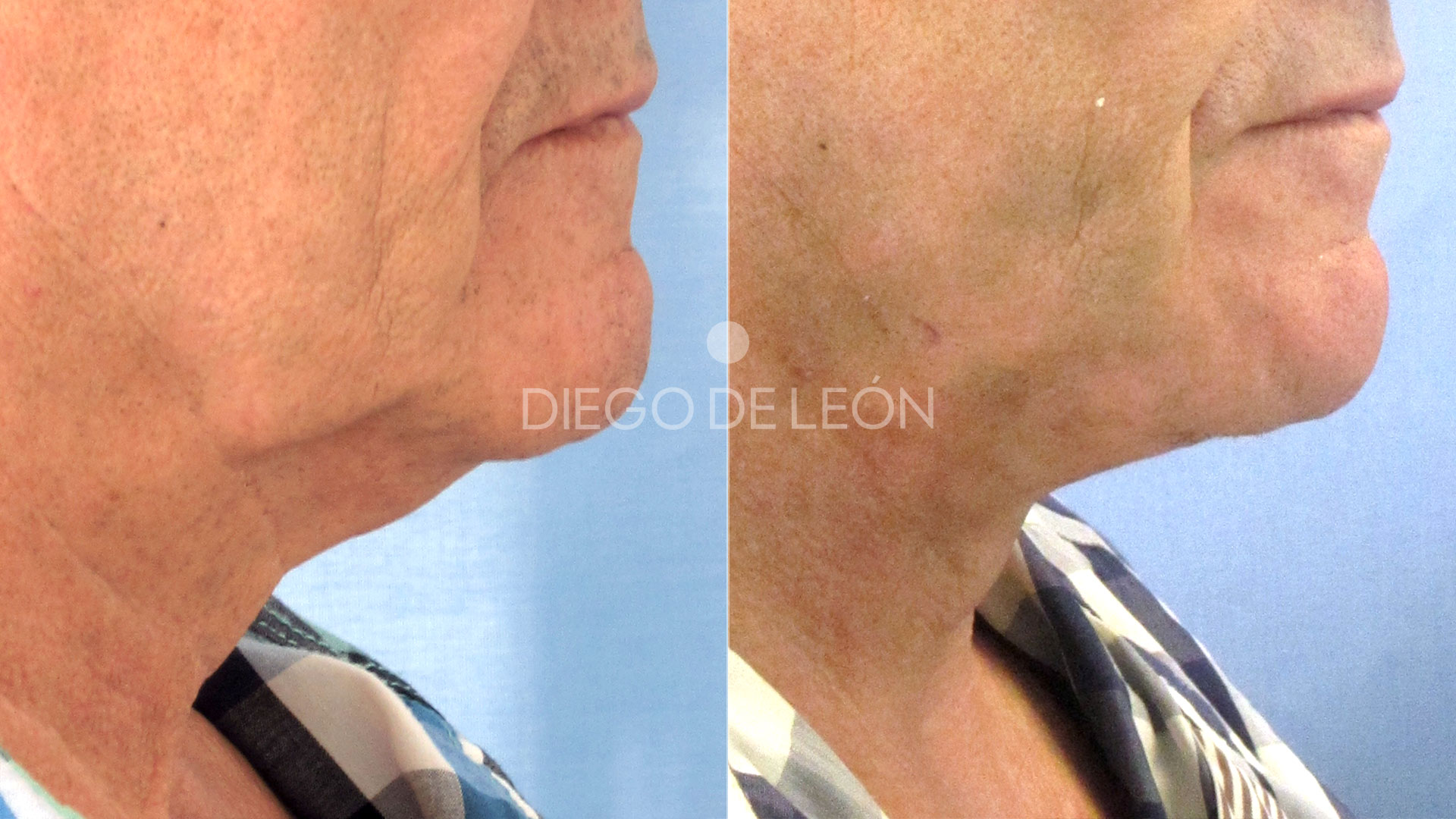 Lifting facial testimonio: cirugía masculina