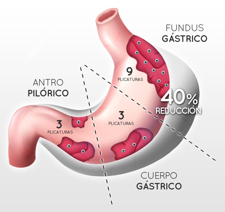 Método POSE vertical reforzado | Clínicas Diego de León 