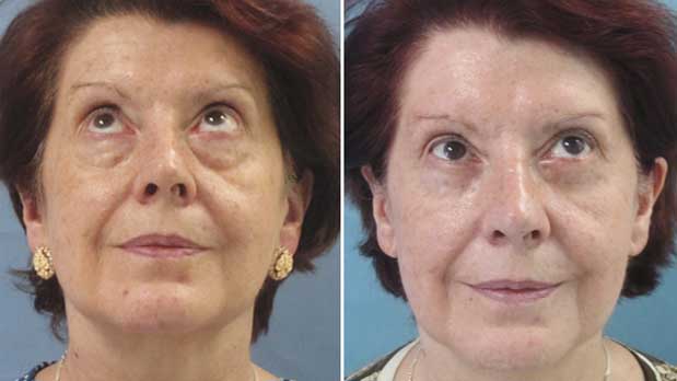 Blefaroplastia Antes y después