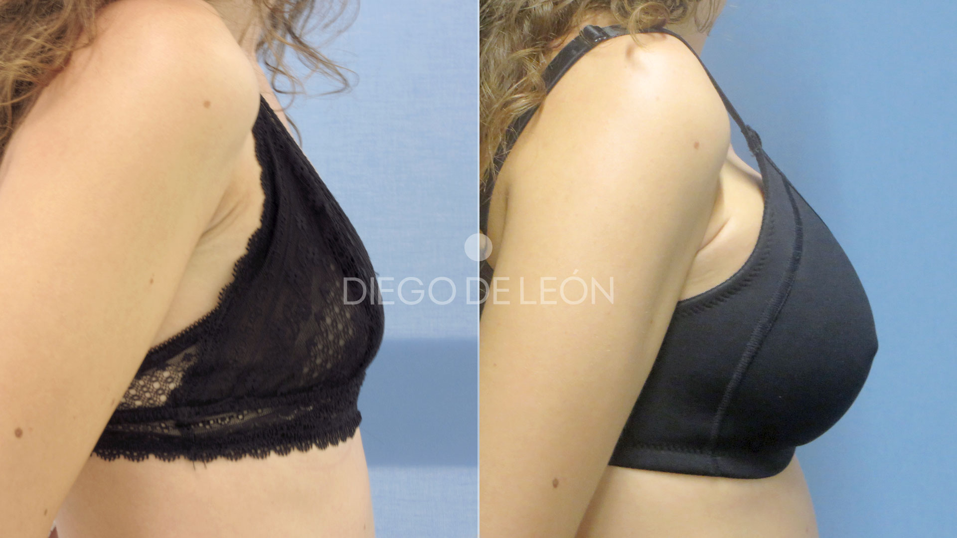 Aumento de Senos con Mastopexia | Antes y Después