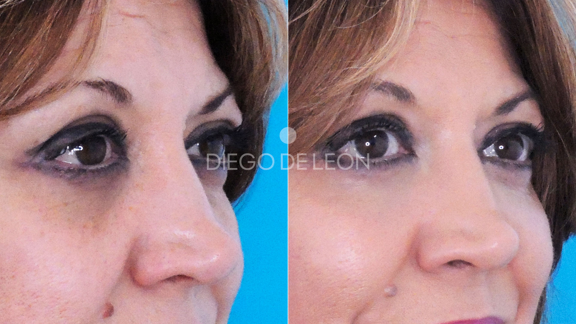 Quitar ojeras con Ácido Hialurónico | Testimonio