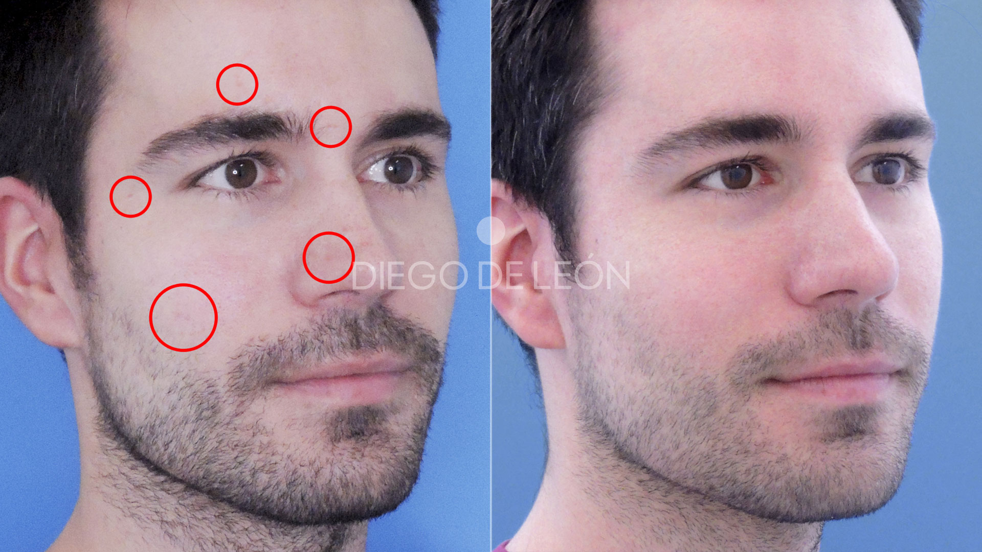 Opiniones Láser Fraxel para eliminar marcas de varicela y acné