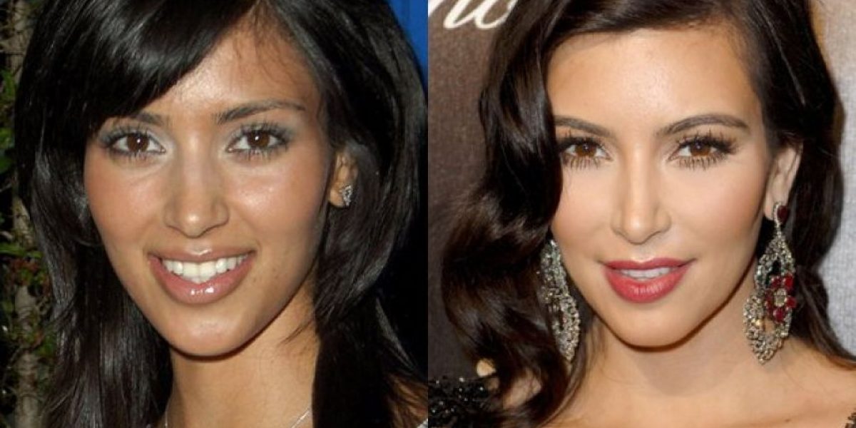 Los tratamientos de medicina estética de Kim Kardashian 
