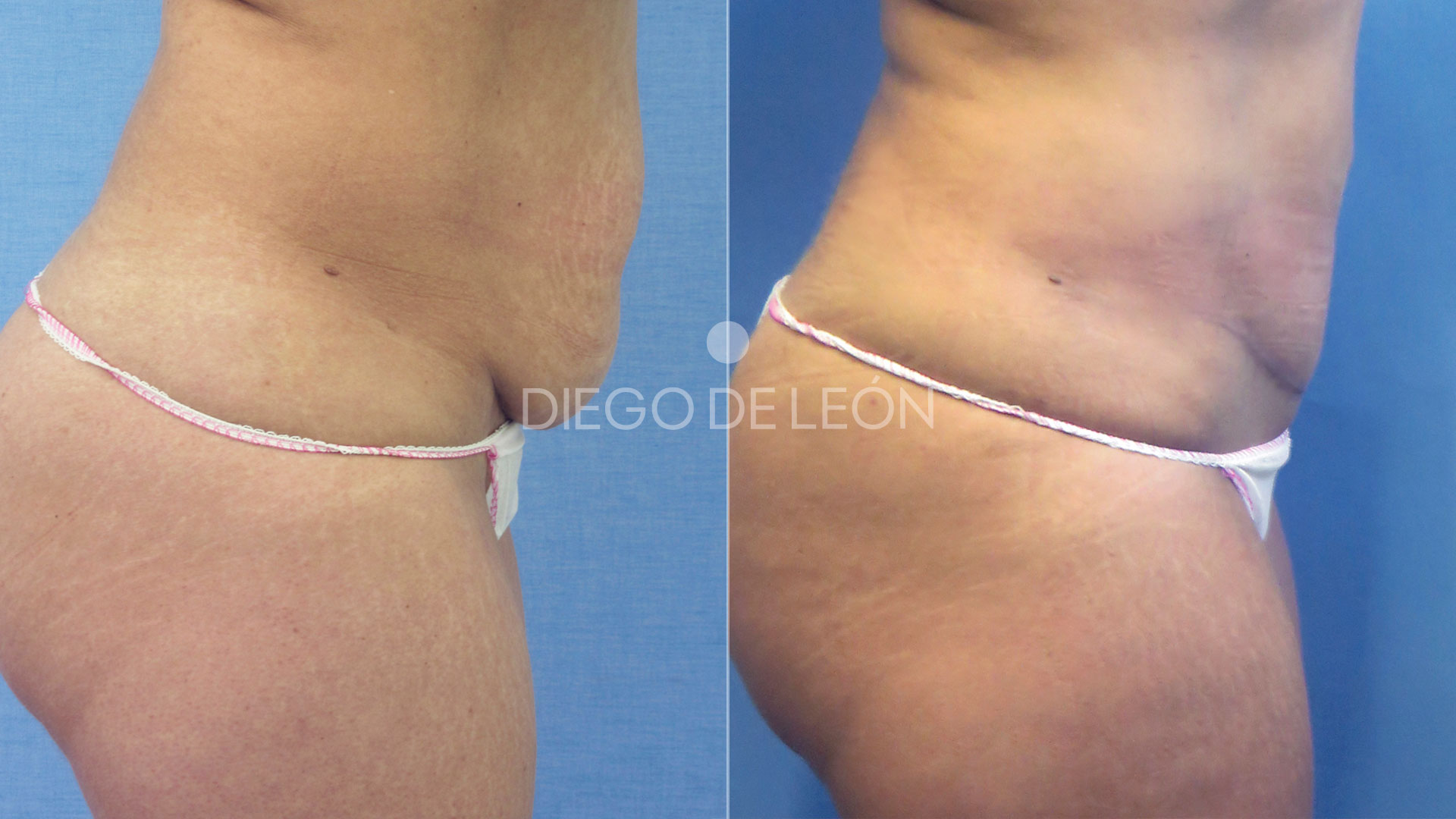 Abdominoplastia | Antes y después