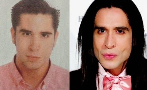 Antes y Después de Bolas de Bichat de Mario Vaquerizo