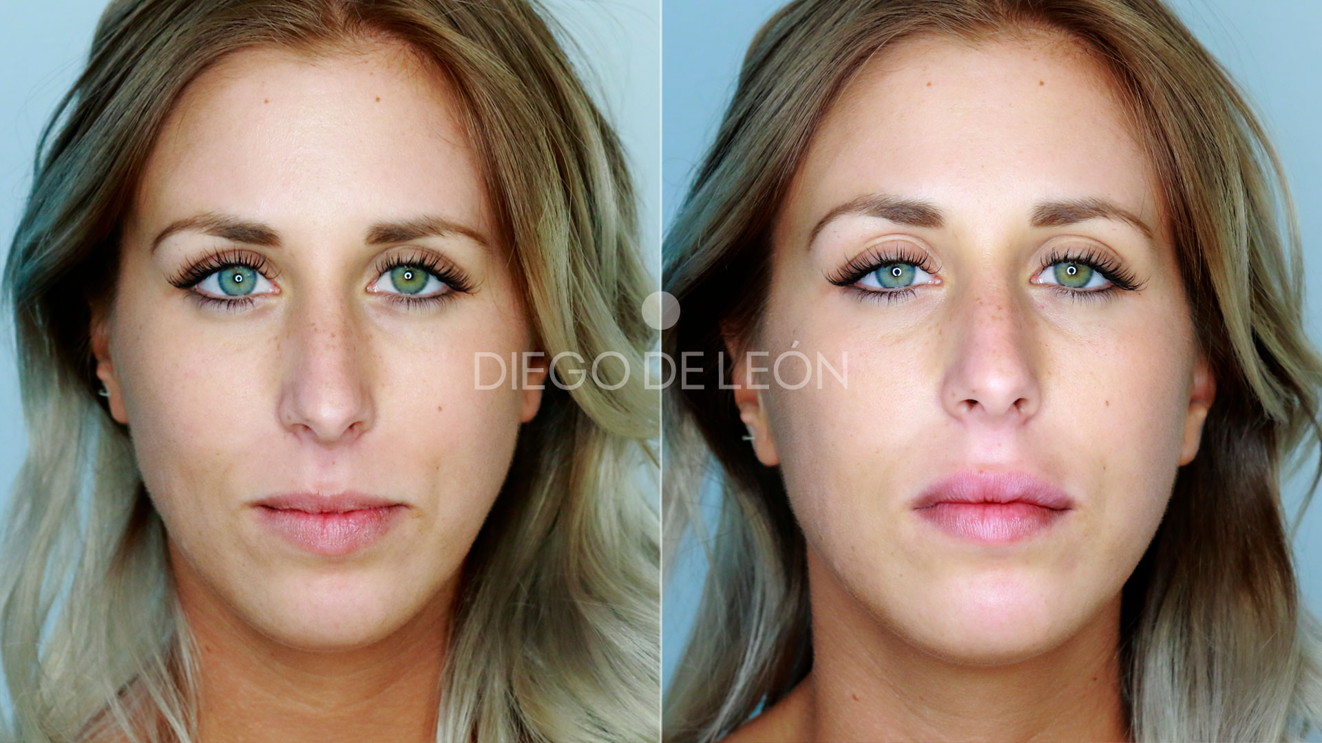 Cómo es el resultado de un relleno de labios