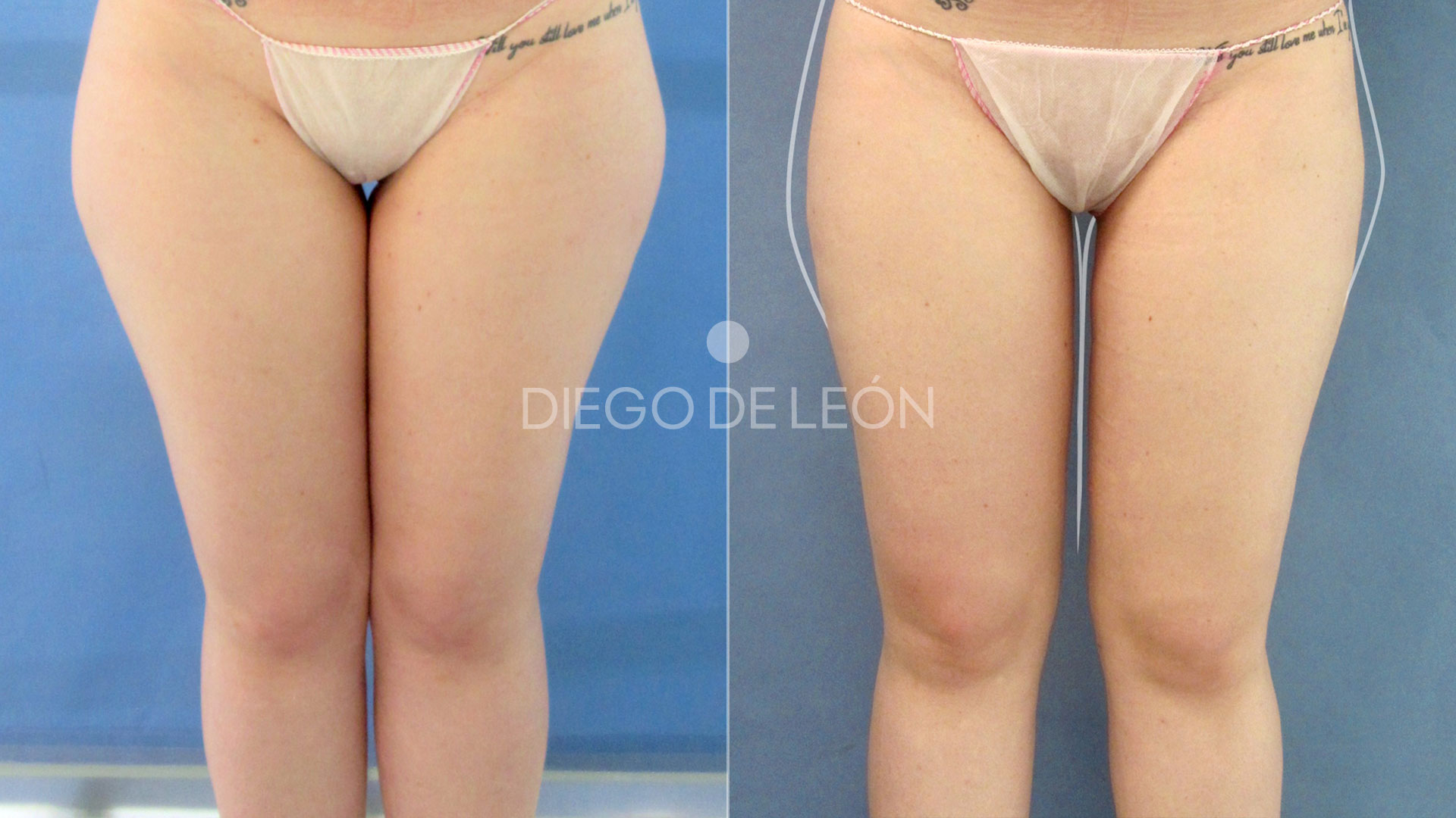 Liposucción de Piernas y Cartucheras | Resultado