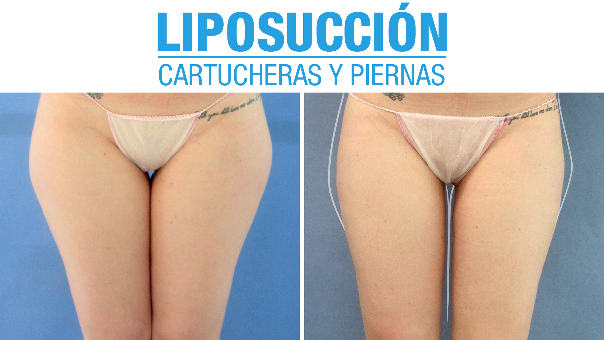 Liposucción de piernas y cartucheras