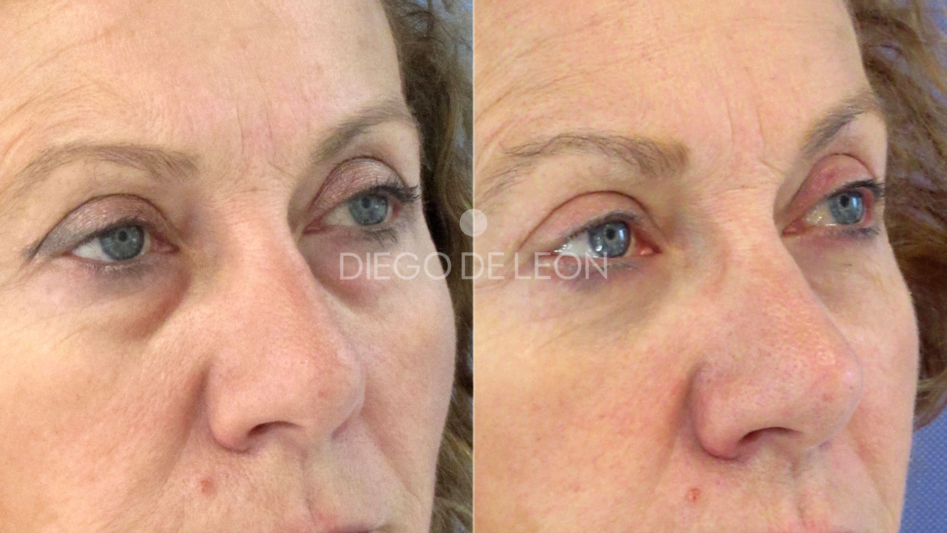 Operación de ojeras | Resultados