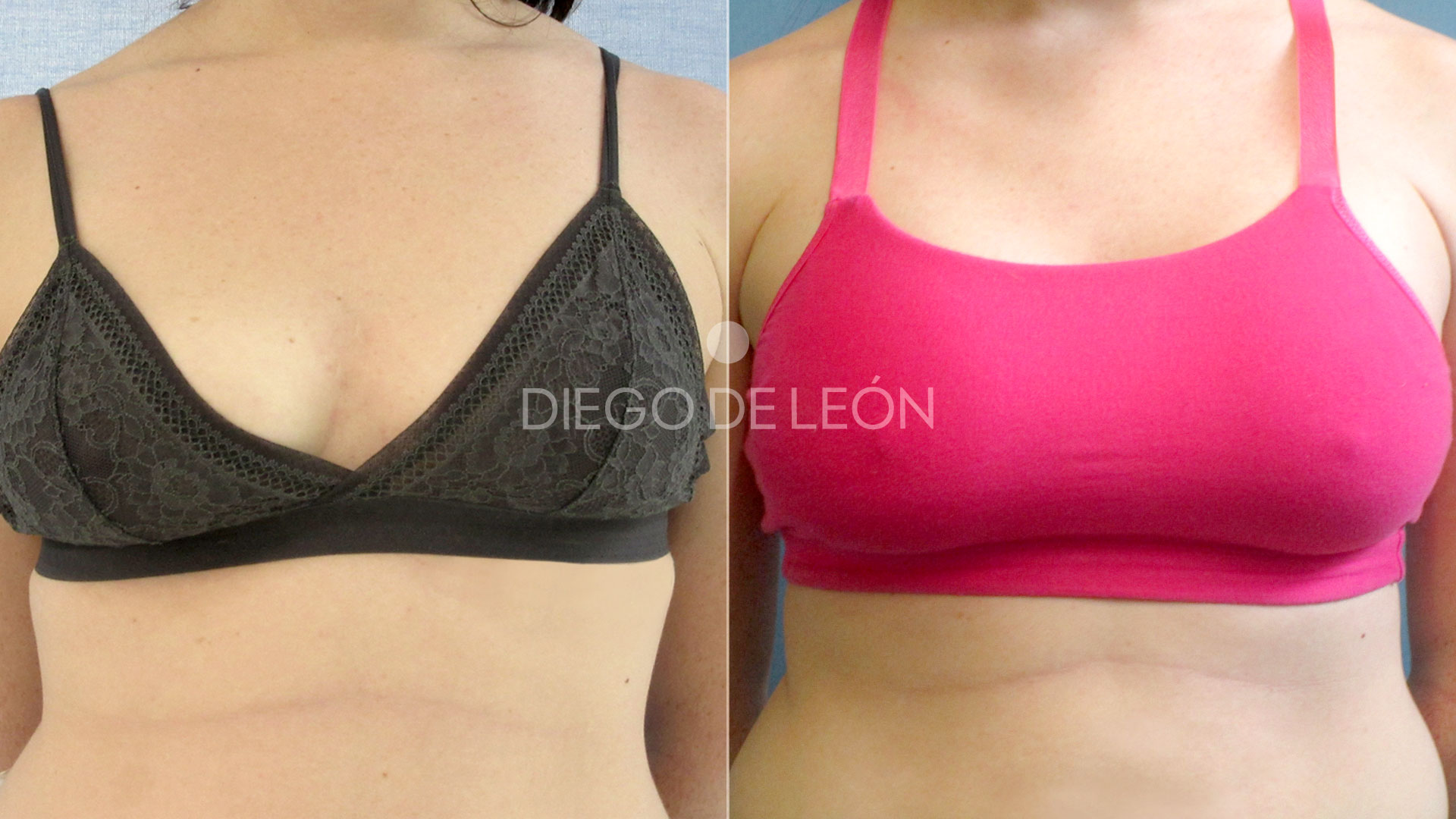 Mamas tuberosas y mastopexia | Testimonio