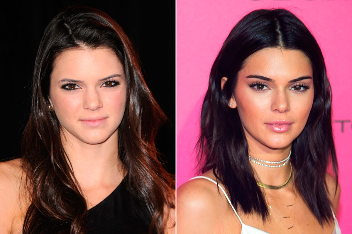 Antes y Después Kendall Jenner - Rellenos ácido hialurónico