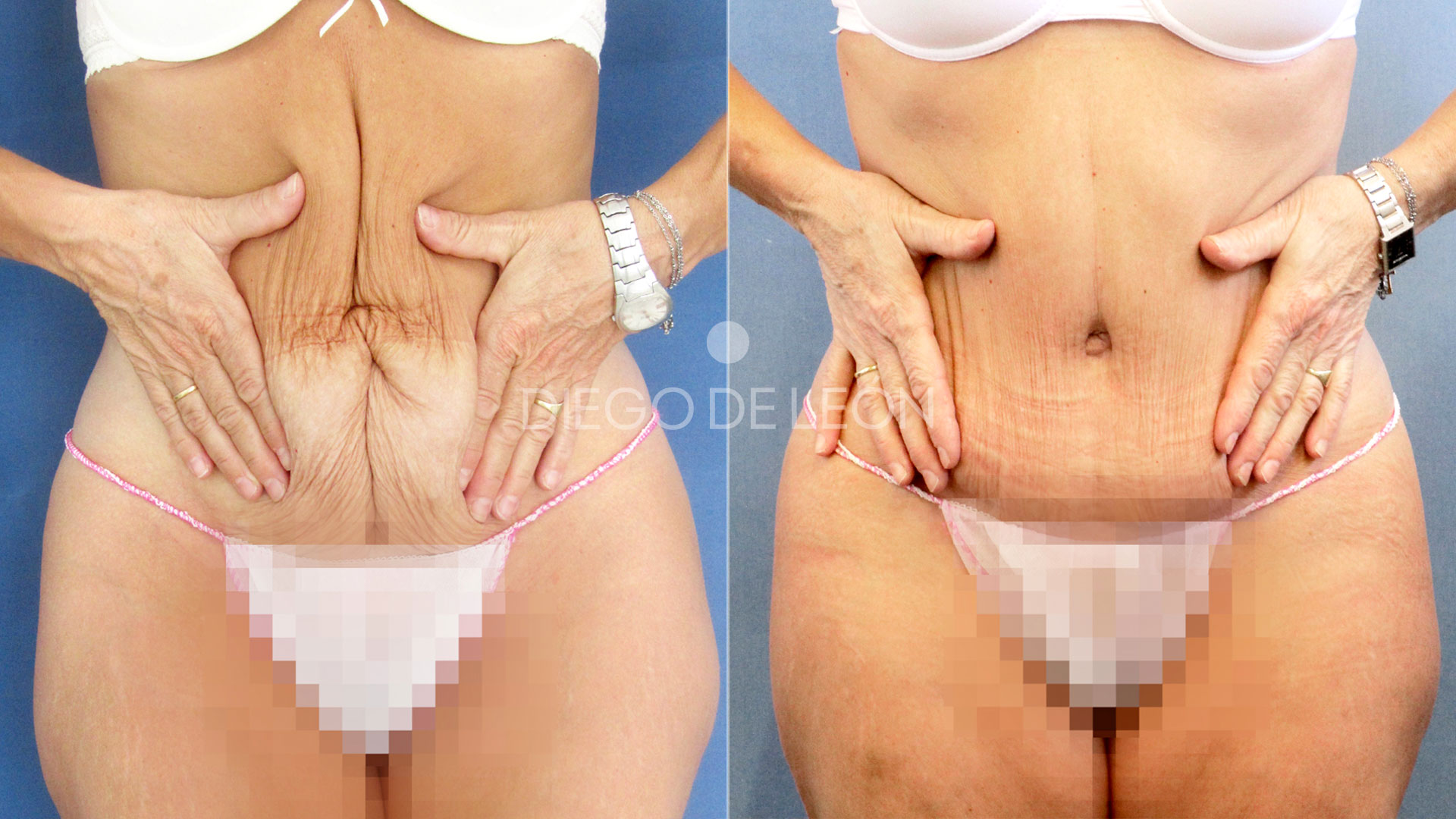 Abdominoplastia después del embarazo | Resultados