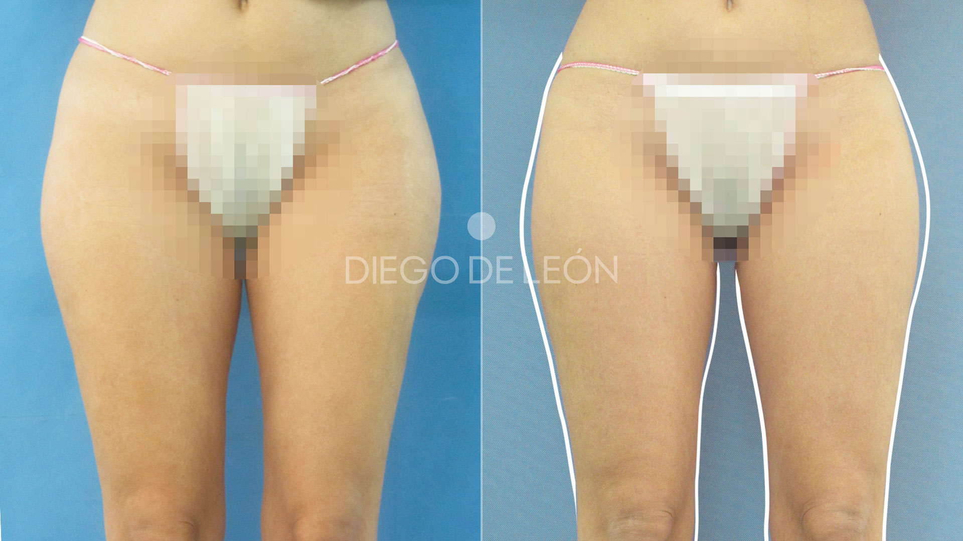 Eliminar Cartucheras | Resultados de Mini Liposucción