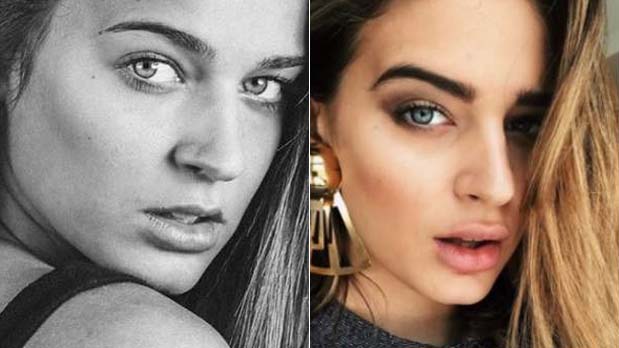 Relleno de Labios: Mitos y Verdades