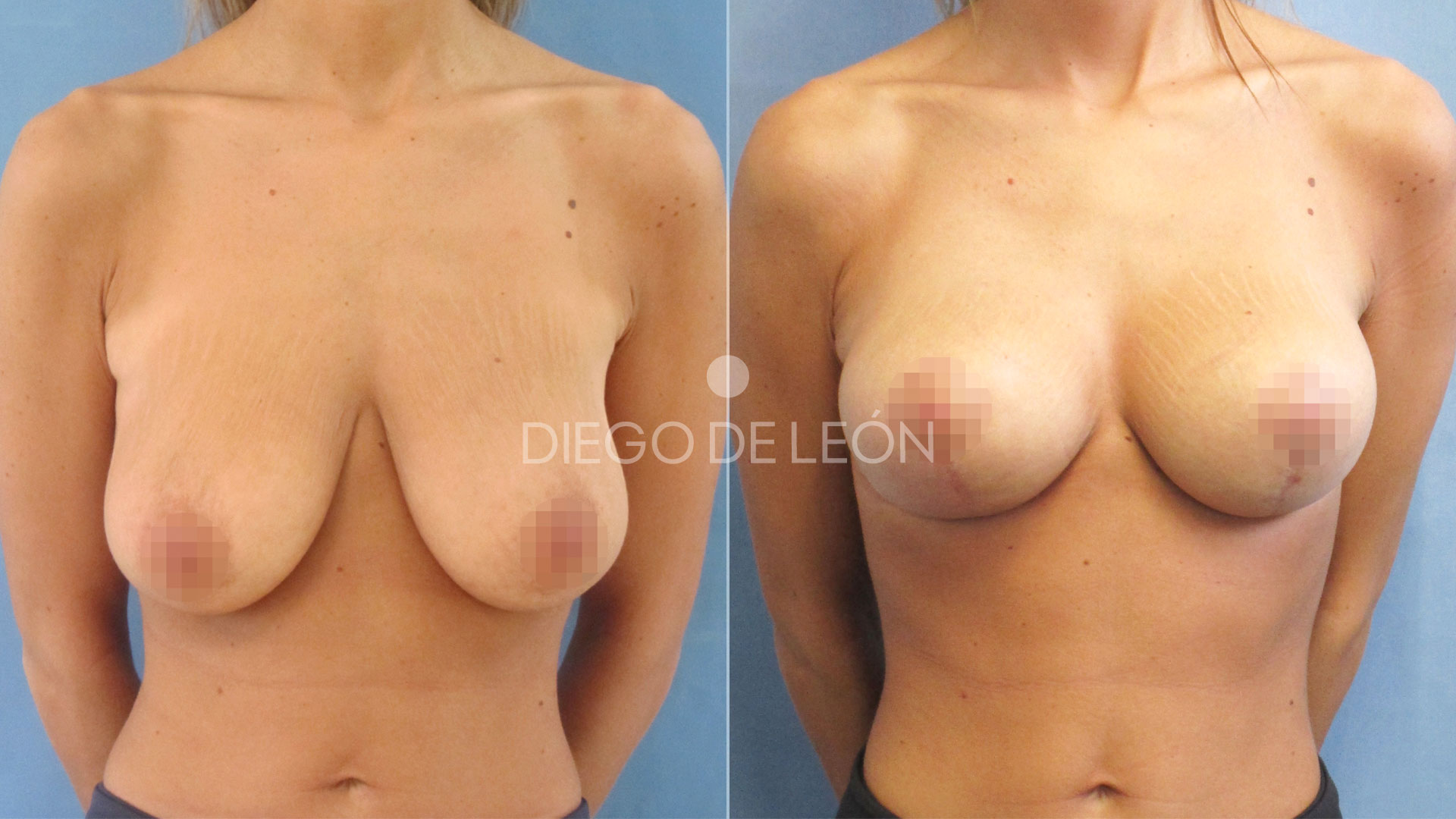 Mastopexia sin implantes | Resultados